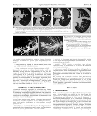 Radiodiagnostic Angioscanographie des artères pulmonaires 32-214-A-10 
*A *B *C 
23 Malformation artérioveineuse chez un homme de 33 ans présentant une maladie de Rendu-Osler en angioscanner en coupe de 3 mm. 
A, B, C. Les coupes axiales montrent une seule artère afférente aux dépens de la segmentaire inférieure de la lingulaire A4 (flèche 
courte), la veine efférente dilatée (tête de flèche) et le sac anévrismal (flèche longue). 
D. Reconstruction 3D maximum intensity projection (MIP) confirmant bien la nature vasculaire de l’image périphérique et son 
caractère non complexe. 
*A *B 
– la (ou les) artère(s) afférente(s) et la (ou les) veine(s) efférente(s) 
dilatée(s). On décrit deux grands types morphologiques de 
MAVP [53] : 
– le type simple qui possède un pédicule artériel unique, quel 
que soit le nombre de pédicules veineux ; 
– le type complexe qui comprend plusieurs pédicules artériels. 
L’acquisition se fait sur un volume d’intérêt localisé sur le sac 
anévrismal et leurs pédicules vasculaires jusqu’au hile, avec des 
coupes de 2 ou 3 mm et un pitch de 2, mais en utilisant un 
chevauchement de 50 % lors de la reconstruction des coupes 
horizontales. L’injection de produit de contraste est nécessaire pour 
identifier un thrombus dans le sac anévrismal et permet une étude 
des vaisseaux systémiques participant à la perfusion du sac 
anévrismal. L’identification des artères afférentes à la MAV se fait à 
la fois sur les coupes natives, et sur des reconstructions 3D plutôt de 
type SSD avec double seuillage ou VRT (fig 23, 24) [31]. 
ANÉVRISMES ARTÉRIELS PULMONAIRES 
Ce sont des dilatations fusiformes ou sacciformes des artères 
pulmonaires au sein desquelles l’angioscanner retrouve des zones 
de thrombose murale plus ou moins abondante. Des plages de 
« verre dépoli » sont parfois visibles autour de ces anévrismes en 
rapport avec des épisodes d’hémorragie par fissuration. Ces 
anévrismes peuvent être d’origine : 
– congénitale : un anévrisme artériel pulmonaire est rarement 
associé à des anomalies congénitales du coeur et des gros vaisseaux, 
mais paraît plutôt compliquer un rétrécissement orificiel 
pulmonaire [24] ; 
– traumatique : un traumatisme thoracique ou plus fréquemment un 
traumatisme direct chirurgical ou via un cathéter intravasculaire de 
Swan-Ganz peuvent générer un faux anévrisme artériel ; 
*D 
24 Reconstruction 3D maximum intensity projection 
(MIP) (A) et rendu de volume (VRT) (B) d’une malformation 
artérioveineuse (MAV) chez une femme de 51 ans présentant 
une maladie de Rendu-Osler. 
A. Reconstruction MIP d’une MAV alimentée par une 
artère issue d’une sous-segmentaire de A8 (flèche lon-gue) 
avec deux veines efférentes (flèches courtes). 
B. Reconstruction VRT avec vue sous une angulation 
différente. Artère (flèche longue) et veines (flèches cour-tes) 
sont également bien vues avec un effet de transpa-rence. 
– infectieuse : la tuberculose (anévrisme de Rasmussen), la syphilis 
et une origine mycotique peuvent être également mises en cause, 
notamment chez les drogués ; 
– vasculaire : l’HTAP primitive ou secondaire à une affection 
cardiovasculaire ou pulmonaire est un facteur de formation 
d’anévrisme pulmonaire ; 
– inflammatoire : maladie de Behçet et syndrome de Hughes-Stovin, 
affection inconnue et rare caractérisée par des anévrismes des artères 
pulmonaires centrales ou périphériques. Certains auteurs 
considèrent ce syndrome comme une variante de la maladie de 
Behçet [54]. 
Le scanner est également essentiel dans l’évaluation 
préthérapeutique de ces anévrismes pour préciser les vaisseaux à 
occlure. Les coupes axiales, les reconstructions 3D VRT et MIP 
permettent d’identifier les relations du sac anévrismal et l’artère à 
occlure, le nombre d’anévrismes, l’orientation et le calibre des artères 
avant cathétérisme [7, 35]. 
VASCULARITES 
¦ Maladie de Behçet 
Cette vascularite, rare, est responsable d’atteinte pleuropulmonaire 
chez 5 % des patients et se traduit le plus souvent par des 
anévrismes des artères pulmonaires (vrai ou faux anévrismes). 
L’angioscanner est l’examen de choix pour le diagnostic et 
l’évaluation préthérapeutique, en cas d’hémoptysie par fissuration 
ou rupture de ces anévrismes et dans le suivi de ces patients (fig 25). 
Les coupes axiales ou les reconstructions 2D et 3D visualisent bien 
ces anévrismes développés sur les branches lobaires, segmentaires 
ou sous-segmentaires, en général multiples, bilatéraux et de taille 
variable, habituellement de plusieurs centimètres [14, 49]. Les contours 
apparaissent parfois mal limités en rapport avec un épisode 
d’hémorragie, d’infection ou de fibrose. L’angioscanner peut 
13 
 