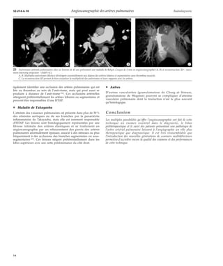 32-214-A-10 Angioscanographie des artères pulmonaires Radiodiagnostic 
*A *B *C 
25 Anévrismes artériels pulmonaires chez un homme de 42 ans présentant une maladie de Behçet. Coupes de 2 mm en angioscanographie (A, B) et reconstruction 3D « maxi-mum 
intensity projection » (MIP) (C). 
A, B. Multiples anévrismes (flèches) développés essentiellement aux dépens des artères lobaires et segmentaires sans thrombose associée. 
C. La reconstruction 3D permet de bien visualiser la multiplicité des anévrismes et leurs rapports avec les artères. 
également identifier une occlusion des artères pulmonaires qui est 
liée au thrombus au sein de l’anévrisme, mais qui peut aussi se 
produire à distance de l’anévrisme [54]. Ces occlusions artérielles 
atteignent préférentiellement les artères lobaires ou segmentaires et 
peuvent être responsables d’une HTAP. 
¦ Maladie de Takayashu 
L’atteinte des vaisseaux pulmonaires est présente dans plus de 30 % 
des atteintes aortiques ou de ses branches par la panartérite 
inflammatoire de Takayashu, mais elle est rarement responsable 
d’HTAP. Les lésions sont histologiquement représentées par une 
fibrose intimale des artères élastiques et se traduisent en 
angioscanographie par un rehaussement des parois des artères 
pulmonaires anormalement épaisses, associé à des sténoses ou plus 
fréquemment à des occlusions des branches segmentaires ou sous-segmentaires 
[25]. Ces lésions siègent préférentiellement dans les 
lobes supérieurs avec une nette prédominance du côté droit. 
¦ Autres 
D’autres vascularites (granulomatose de Churg et Strauss, 
granulomatose de Wegener) peuvent se compliquer d’atteinte 
vasculaire pulmonaire dont la traduction n’est le plus souvent 
qu’histologique. 
Conclusion 
Les multiples possibilités qu’offre l’angioscanographie ont fait de cette 
technique un examen essentiel dans le diagnostic, le bilan 
préthérapeutique et le suivi des patients présentant une pathologie de 
l’arbre artériel pulmonaire laissant à l’angiographie un rôle plus 
thérapeutique que diagnostique. Il est très vraisemblable que 
l’introduction des nouvelles générations de scanners multidétecteurs 
permettra d’accroître encore la qualité des examens et des performances 
de cette technique. 
14 
 