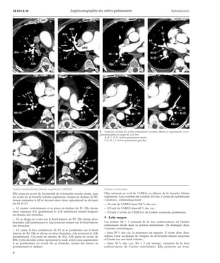 32-214-A-10 Angioscanographie des artères pulmonaires Radiodiagnostic 
*A *B *C *D 
*E *F *G *H 
Artère médiastinale lobaire supérieure (AMLS) 
Elle passe en avant de l’extrémité de la bronche souche droite, puis 
en avant de la bronche lobaire supérieure, restant en dedans de B2, 
donne naissance à A2 et devient alors tronc apicodorsal se divisant 
en A1 et A3. 
– A1 monte verticalement et se place en dedans de B1. Elle donne 
deux rameaux A1a (postérieur) et A1b (antérieur) restant toujours 
en dedans des bronches. 
– A2 se dirige en avant sur le bord interne de B2. Elle donne deux 
branches A2b (antérieure) et A2a (externe) restant sur le bord interne 
des bronches. 
– A3 croise la face postérieure de B1 et se positionne sur le bord 
interne de B3. Elle se divise en deux branches, A3a (externe) et A3b 
(postérieure). A3a reste en dedans de B3a, A3b passe en avant de 
B3b. Cette dernière artère représente la seule artère sous-segmentaire 
à se positionner en avant de sa bronche, toutes les autres se 
positionnant en dedans. 
1 Anatomie normale des artères pulmonaires normales lobaires et segmentaires en an-gioscanographie 
en coupes de 1,25 mm. 
A, B, C, D, E. Artères pulmonaires droites. 
F, G, H, I, J. Artères pulmonaires gauches. 
Artères scissurales 
Elles naissent en aval de l’AMLS, en dehors de la bronche lobaire 
supérieure. Leur nombre est variable. En fait, il existe de nombreuses 
variations ; schématiquement : 
– A1 naît de l’AMLS dans 100 % des cas ; 
– A2 naît de l’AMLS dans 60 % des cas ; 
– A3 naît à la fois de l’AMLS et de l’artère scissurale postérieure. 
¦ Lobe moyen 
Les artères A4 + 5 naissent de la face antéroexterne de l’artère 
pulmonaire droite dans sa portion interlobaire. On distingue deux 
variantes anatomiques : 
– dans 50 % des cas, la naissance est séparée. Il existe alors deux 
artères, l’une au-dessus de l’origine de la bronche lobaire moyenne 
et l’autre sur son bord externe ; 
– dans 50 % des cas, A4 + 5 est unique, naissant de la face 
antéroexterne de l’artère interlobaire. Elle présente un tronc 
*I *J 
2 
 
