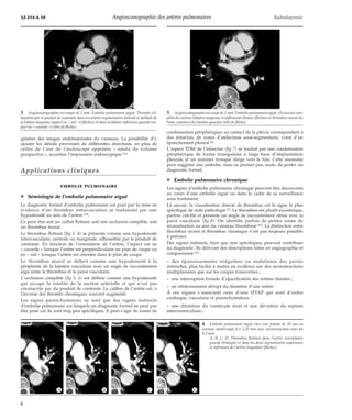 32-214-A-10 Angioscanographie des artères pulmonaires Radiodiagnostic 
générer des images endoluminales du vaisseau. La possibilité d’y 
ajouter les détails provenant de différentes directions, en plus de 
celles de l’axe de l’endoscope appelées « rendu de volume 
perspective », accentue l’impression endoscopique [43]. 
Applications cliniques 
EMBOLIE PULMONAIRE 
¦ Sémiologie de l’embolie pulmonaire aiguë 
Le diagnostic formel d’embolie pulmonaire est posé par la mise en 
évidence d’un thrombus intravasculaire se traduisant par une 
hypodensité au sein de l’artère [23]. 
Ce peut être soit un caillot flottant, soit une occlusion complète, soit 
un thrombus mural. 
Le thrombus flottant (fig 3, 4) se présente comme une hypodensité 
intravasculaire, centrale ou marginale, silhouettée par le produit de 
contraste. En fonction de l’orientation de l’artère, l’aspect est en 
« cocarde » lorsque l’artère est perpendiculaire au plan de coupe ou 
en « rail » lorsque l’artère est orientée dans le plan de coupe. 
Le thrombus mural se définit comme une hypodensité à la 
périphérie de la lumière vasculaire avec un angle de raccordement 
aigu entre le thrombus et la paroi vasculaire. 
L’occlusion complète (fig 5, 6) est définie comme une hypodensité 
qui occupe la totalité de la section artérielle et qui n’est pas 
circonscrite par du produit de contraste. Le calibre de l’artère est, à 
l’inverse des thrombi chroniques, souvent augmenté. 
Les signes parenchymateux ne sont que des signes indirects 
d’embolie pulmonaire sur lesquels un diagnostic formel ne peut pas 
être posé car ils sont trop peu spécifiques. Il peut s’agir de zones de 
5 Angioscanographie en coupe de 2 mm. Embolie pulmonaire aiguë. Occlusion com-plète 
des artères lobaires moyenne et inférieures droites (flèches) et thrombus mural du 
tronc commun des basales gauches (tête de flèche). 
condensation périphériques au contact de la plèvre correspondant à 
des infarctus, de zones d’atélectasie sous-segmentaire, voire d’un 
épanchement pleural [6]. 
L’aspect TDM de l’infarctus (fig 7) se traduit par une condensation 
périphérique de forme triangulaire à large base d’implantation 
pleurale et un sommet tronqué dirigé vers le hile. Cette anomalie 
peut suggérer une embolie, mais ne permet pas, seule, de porter un 
diagnostic formel. 
¦ Embolie pulmonaire chronique 
Les signes d’embolie pulmonaire chronique peuvent être découverts 
au cours d’une embolie aiguë ou dans le cadre de sa surveillance 
sous traitement. 
Là encore, la visualisation directe de thrombus est le signe le plus 
spécifique de cette pathologie [3]. Le thrombus est plutôt excentrique, 
parfois calcifié et présente un angle de raccordement obtus avec la 
paroi vasculaire (fig 8). On identifie parfois de petites zones de 
recanalisation au sein du vaisseau thrombosé [47]. La distinction entre 
thrombus récent et thrombus chronique n’est pas toujours possible 
à préciser. 
Des signes indirects, bien que non spécifiques, peuvent contribuer 
au diagnostic. Ils dérivent des descriptions faites en angiographie et 
comprennent [22] : 
– des épaississements irréguliers ou nodulaires des parois 
artérielles, plus faciles à mettre en évidence sur des reconstructions 
multiplanaires que sur les coupes transverses ; 
– une interruption brutale d’opacification des artères distales ; 
– un rétrécissement abrupt du diamètre d’une artère. 
À ces signes s’associent ceux d’une HTAP qui sont d’ordre 
cardiaque, vasculaire et parenchymateux : 
– une dilatation du ventricule droit et une déviation du septum 
interventriculaire ; 
3 Angioscanographie en coupe de 2 mm. Embolie pulmonaire aiguë. Thrombi sil-houettés 
par le produit de contraste dans les artères segmentaires latérale et médiale de 
la lobaire moyenne (aspect en « rail ») (flèches) et dans la lobaire inférieure gauche (as-pect 
en « cocarde ») (tête de flèche). 
4 Embolie pulmonaire aiguë chez une femme de 59 ans en 
scanner multicoupe 4 ´ 1,25 mm avec reconstruction tous les 
0,5 mm. 
A, B, C, D. Thrombus flottant dans l’artère interlobaire 
gauche (triangle) et dans les deux segmentaires supérieure 
et inférieure de l’artère lingulaire (flèches). 
*A *B *C *D 
6 
 