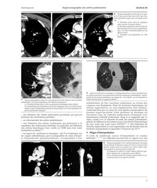 Radiodiagnostic Angioscanographie des artères pulmonaires 32-214-A-10 
*A *B *C 
*A *B 
– une dilatation des artères pulmonaires proximales qui peuvent 
présenter des calcifications pariétales ; 
– un rétrécissement des artères périphériques ; 
– une dilatation des artères systémiques qui participent à la 
suppléance des obstructions artérielles, en particulier une dilatation 
des artères bronchiques bien visible en TDM dans leur trajet 
médiastinal ou hilaire [19] ; 
– un aspect de « perfusion en mosaïque » (fig 9) se traduisant, sur 
les coupes millimétriques, par la juxtaposition de zones d’hyper-et 
d’hypodensité parenchymateuses, correspondant à une 
6 Angioscanographie multicoupe en coupes 
de 1,25 mmreconstruites tous les 0,5 mm. Em-bolie 
pulmonaire aiguë chez un homme de 65 
ans. 
A. Thrombus d’une artère de cinquième 
ordre issue de A1 gauche (flèche). 
B. Thrombus segmentaire obstructif de A6 
(flèche longue) et de ses sous-segmentaires 
A6a + b et A6c et thrombus flottant de A4 
(flèche courte). 
C. Thrombus sous-segmentaire de A5b 
(flèche). 
9 Aspect de perfusion en mosaïque en tomodensitométrie en haute résolution chez 
un homme présentant une hypertension artérielle pulmonaire postembolique : hétéro-généité 
du parenchyme pulmonaire avec plages de « verre dépoli » au sein desquelles le 
calibre des vaisseaux est augmenté (flèche). 
redistribution de flux vasculaire pulmonaire au niveau des 
vaisseaux non thrombosés. Dans les territoires hyperdenses, les 
artères segmentaires ou sous-segmentaires sont dilatées, 
confirmant bien que ces zones de verre dépoli correspondent à du 
poumon hypervascularisé. Cette perfusion en mosaïque est 
rencontrée dans les embolies pulmonaires chroniques avec 
hypertension artérielle pulmonaire. King et al suggèrent que ce 
signe, couplé avec la disparité de taille des artères pulmonaires, 
permet de différencier les patients ayant une HTAP postembolique 
de ceux ayant une autre cause d’HTAP [21, 42]. Des dilatations de 
bronches segmentaires et sous-segmentaires ont été décrites dans les 
territoires hypoperfusés et rapportées à l’hypoxie (fig 10) [40]. 
¦ Pièges d’interprétation 
Il existe de nombreuses erreurs d’interprétation en scanner 
hélicoïdal [1, 13, 37]. Ces difficultés peuvent être en rapport avec des 
7 Angioscanographie en coupe de 2 mm passant par le lobe inférieur droit en fenêtre 
médiastinale (A) et parenchymateuse (B). Infarctus pulmonaire. 
A. Thrombus flottant dans l’artère segmentaire postérobasale droite (flèche). 
B. Condensation parenchymateuse de forme triangulaire dans le territoire posté-robasal, 
à base d’implantation pleurale et sommet dirigé vers le hile traduisant l’in-farctus 
pulmonaire (triangle). 
8 Angioscanographie d’une embolie pulmonaire chronique 
chez une femme de 40 ans en coupes de 2 mmet reconstruction 
jointive. Coupe axiale (A) passant par l’artère lobaire infé-rieure 
gauche et reconstruction coronale (B). 
A. Disparité de calibre de l’artère lobaire inférieure gau-che 
en rapport avec un thrombus mural (flèche). 
B. Les reconstructions 2D coronales montrent bien le rac-cordement 
obtus avec la paroi artérielle. 
*A *B 
7 
 
