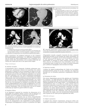 32-214-A-10 Angioscanographie des artères pulmonaires Radiodiagnostic 
*A *B 
*A *B 
pièges anatomiques, des problèmes techniques ou des conditions 
physiopathologiques particulières. Ces difficultés d’interprétation 
sont de moins en moins problématiques avec l’expérience et la 
plupart d’entre elles sont résolues avec le scanner multicoupe qui 
autorise des coupes plus fines et une apnée moins longue. 
Pièges anatomiques 
· Anatomie vasculaire 
L’interprétation dans le diagnostic d’embolie pulmonaire sous-entend 
une connaissance précise de l’anatomie des artères 
pulmonaires. Il importe de savoir reconnaître les artères et de faire 
la distinction entre artères et veines sur les coupes axiales. Les veines 
pulmonaires peuvent être plus faiblement opacifiées et ne doivent 
pas être confondues avec une artère partiellement thrombosée 
(fig 11). Cette identification nécessite la confrontation des fenêtres 
médiastinales, mais aussi parenchymateuses pour repérer les artères 
en fonction de leur topographie juxtabronchique. Les veines 
pulmonaires ont, elles, un trajet indépendant intersegmentaire. Dans 
tous les cas, il est nécessaire de visualiser la succession des coupes 
axiales, préférentiellement sous le mode du défilement en cine-view 
sur la console de travail pour reconnaître les éléments veineux et les 
variantes anatomiques. Cela est d’autant plus vrai avec le scanner 
multicoupe qui requiert un grand nombre de coupes. 
· Ganglions hilaires 
Il est également impératif de connaître les dimensions et la 
topographie des ganglions hilaires normaux afin de distinguer un 
thrombus mural d’un ganglion lymphatique périartériel [37, 41]. 
Ces ganglions se présentent sous la forme d’hypodensités 
renfermant parfois des calcifications le plus souvent situées entre les 
axes bronchiques du hile et les artères pulmonaires adjacentes 
(fig 12). Ils correspondent à des conglomérats de petits ganglions 
lymphatiques histologiquement normaux ou présentant des signes 
10 Hypertension artérielle pulmonaire postembolique chez 
un homme de 39 ans. 
A. Angioscanographie en coupe de 3 mm : les artères de 
la pyramide basale gauche sont de petit calibre (flèche). 
B. Tomodensitométrie en haute résolution : hypoperfu-sion 
dans le territoire pulmonaire correspondant et aug-mentation 
du calibre des bronches segmentaires (trian-gle). 
d’hyperplasie sinusale, auxquels s’associent du tissu conjonctif 
péribronchovasculaire et des branches des artères bronchiques. En 
règle générale, ces ganglions sont de forme triangulaire ou linéaire 
et leur épaisseur ne dépasse pas 3 mm. Lorsqu’ils sont 
hypertrophiés, ils prennent un aspect nodulaire parfois trompeur. 
Pour pouvoir les différencier d’un thrombus mural, une 
reconstruction dans le grand axe de l’artère est parfois nécessaire 
pour confirmer la topographie extravasculaire de l’image. 
· Impactions mucoïdes 
L’analyse du rapport juxtabronchique de l’artère sur les fenêtres 
parenchymateuses permet de ne pas confondre une impaction 
mucoïde avec un thrombus pulmonaire complètement obstructif 
(fig 13). 
· Orientation des artères 
Des erreurs diagnostiques peuvent être générées par l’orientation 
des vaisseaux : un trajet horizontal ou oblique d’une artère peut 
générer des hypodensités (fig 14) pouvant être confondues avec une 
embolie pulmonaire sur les coupes axiales [1]. Ces hypodensités sont 
essentiellement dues à un effet de volume partiel entre le 
parenchyme pulmonaire, la paroi de l’artère et le sang. Les vaisseaux 
concernés sont les artères segmentaires antérieures des lobes 
supérieurs, les artères lobaires moyenne et lingulaire et l’artère 
segmentaire apicale des lobes inférieurs. Ces difficultés sont résolues 
par l’utilisation d’une fine collimation, mais une reconstruction 
chevauchée des coupes, voire une reconstruction bidimensionnelle 
dans le grand axe de l’artère peuvent également être utiles. 
Difficultés techniques 
· Artefacts respiratoires 
La plupart des artefacts respiratoires, lorsqu’on utilise une 
acquisition craniocaudale, concernent les lobes inférieurs en raison 
11 Image piège anatomique. Coupe de 2 mmd’angioscanographie chez une femme de 
61 ans passant par le lobe supérieur droit en fenêtre médiastinale (A) et en fenêtre pa-renchymateuse 
(B). 
A. Hypodensité au sein d’une structure vasculaire (flèche). 
B. Les artères (têtes de flèche) sont satellites des bronches et de topographie anté-rieure 
par rapport à celles-ci. La structure vasculaire « suspecte » a un trajet in-dépendant 
et correspond donc à une veine faiblement opacifiée (flèche longue). 
12 Image piège : ganglion hilaire. Coupe de 1,25 mmen angioscanographie multidé-tecteurs 
chez un homme de 64 ans. Hypodensité (flèche) située entre bronche et artère 
correspondant à un ganglion lymphatique du groupe culminal N1c. 
8 
 
