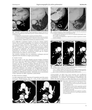 Radiodiagnostic Angioscanographie des artères pulmonaires 32-214-A-10 
*A *B 
de la difficulté à maintenir l’apnée à la fin du volume exploré, 
surtout chez un patient dyspnéique. Ces artefacts se traduisent par 
une opacification artérielle inhomogène et un aspect de 
pseudodefect artériel source de faux positifs et de faux négatifs 
(fig 15). L’analyse des coupes en fenêtre parenchymateuse permet 
de redresser le diagnostic. Aux patients très dyspnéiques, il est 
préférable de demander de respirer lentement et de manière 
superficielle au cours de l’acquisition plutôt que de risquer 
d’interrompre une apnée en cours d’examen. 
Des artefacts cinétiques liés aux battements cardiaques peuvent 
également être rencontrés en région paracardiaque. 
· Artefacts de flux 
Des faux positifs et des faux négatifs peuvent résulter d’artefacts 
issus de la veine cave supérieure et dégradant la qualité des images 
des zones adjacentes. Ces artefacts hypo- et hyperdenses sont 
reconnus par leur orientation radiaire émanant de la veine cave 
supérieure (fig 16). Ils sont principalement visualisés au niveau de 
l’artère pulmonaire droite, de la lobaire supérieure droite et de sa 
segmentaire antérieure. Ces artefacts sont fréquemment rencontrés 
au cours d’acquisition craniocaudale avec un débit d’injection élevé 
et un produit de contraste fortement concentré. Ils sont réduits en 
modifiant ces différents paramètres : diminution de la concentration 
d’iode, réduction du débit, acquisition caudocrâniale. 
· Délai d’injection inadapté 
Un délai inapproprié entre l’injection et l’acquisition peut être source 
d’erreurs diagnostiques (fig 17). Lors d’une acquisition 
15 Artefacts respiratoires. Angioscanographie en coupe de 3 mm chez une femme de 
83 ans en fenêtre médiastinale (A) et parenchymateuse (B). 
A. Hétérogénéité d’opacification des artères de la pyramide basale gauche simu-lant 
un defect intravasculaire. 
B. Les fenêtres parenchymateuses confirment les artefacts respiratoires et de bat-tements 
cardiaques. 
*A *B *C 
craniocaudale, un délai trop court entraîne une insuffisance 
d’opacification des artères pulmonaires du sommet, générant des 
pseudodefects. Au contraire, une insuffisance d’opacification des 
artères des bases est liée à un délai trop long ou à un arrêt trop 
13 Image piège : impaction mucoïde. Angioscanographie en coupe de 2 mm chez un 
homme de 74 ans passant par le lobe inférieur gauche, en fenêtre médiastinale (A) et pa-renchymateuse 
(B). 
A. Hypodensité circonscrite dans le segment postérobasal (flèche). 
B. Les fenêtres parenchymateuses montrent bien que les deux structures artériel-les 
sont postéroexternes à l’hypodensité et l’absence de clarté aérique de la bron-che 
postérobasale. L’hypodensité correspond à une impaction mucoïde. 
14 Image piège : volume partiel lié à l’orientation de l’artère. 
Angioscanographie en coupe de 2 mm, pitch de 2 avec 
reconstruction jointive (A) et reconstruction chevauchée 
tous les millimètres (B). 
A. Hypodensité au sein de l’artère segmentaire ventrale 
du lobe supérieur gauche mimant un thrombus flottant. 
B. L’hypodensité n’est pas retrouvée sur la coupe avec 
reconstruction chevauchée. 
Cette hypodensité peut donc être rapportée à un phéno-mène 
de volume partiel avec le parenchyme pulmonaire 
et la paroi artérielle. 
*A *B 
*A *B 
16 Artefacts de flux. Coupe de 1,25 mm en angioscanographie multidétecteurs pas-sant 
par le lobe supérieur droit chez une femme de 63 ans. 
A, B, C. Artefacts radiaires issus de la veine cave supérieure masquant partielle-ment 
un thrombus dans l’artère médiastinale lobaire supérieure droite (flèche lon-gue). 
À noter un thrombus de la segmentaire apicale (flèche courte). 
9 
 