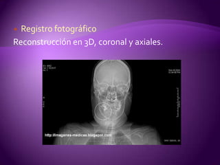  Registro fotográfico
Reconstrucción en 3D, coronal y axiales.
 