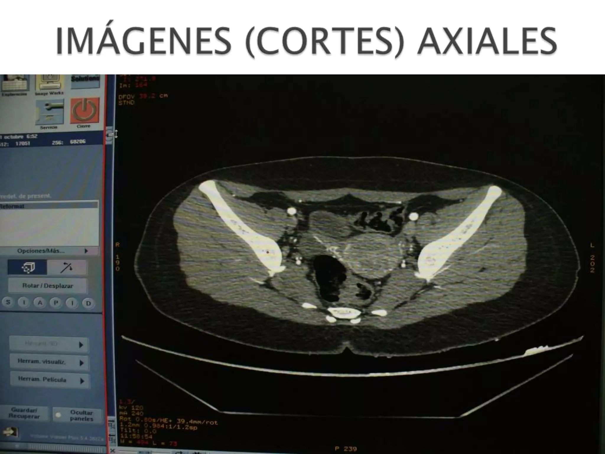 Angiotc De Miembros Inferiores PPTX angiotc-de-miembros-inferiores-pptx