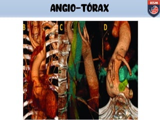 ANGIO-TÓRAX
 