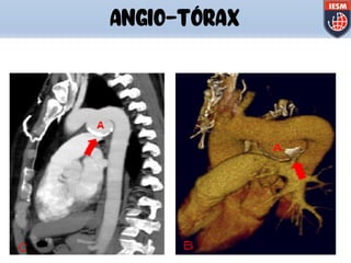 ANGIO-TÓRAX
 