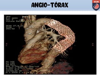 ANGIO-TÓRAX
 