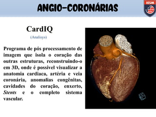 Programa de pós processamento de
imagem que isola o coração das
outras estruturas, reconstruindo-o
em 3D, onde é possivel visualizar a
anatomia cardiaca, artéria e veia
coronária, anomalias congênitas,
cavidades do coração, enxerto,
Stents e o completo sistema
vascular.
CardIQ
(Analisys)
ANGIO-CORONÁRIAS
 