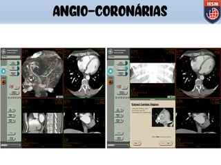 ANGIO-CORONÁRIAS
 