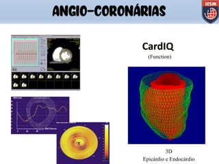 3D
Epicárdio e Endocárdio
CardIQ
(Function)
ANGIO-CORONÁRIAS
 