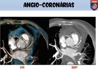 VR MIP
ANGIO-CORONÁRIAS
 