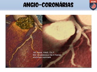 ANGIO-CORONÁRIAS
 