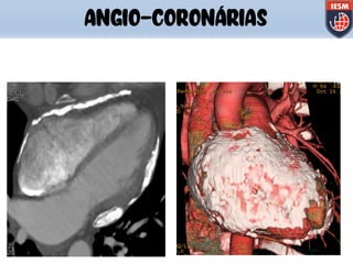 ANGIO-CORONÁRIAS
 