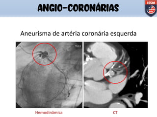 Hemodinâmica CT
Aneurisma de artéria coronária esquerda
ANGIO-CORONÁRIAS
 
