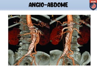 ANGIO-ABDOME
 