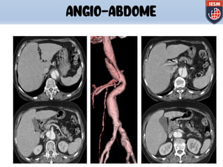 ANGIO-ABDOME
 