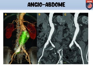 ANGIO-ABDOME
 