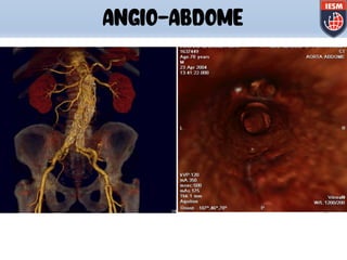 ANGIO-ABDOME
 