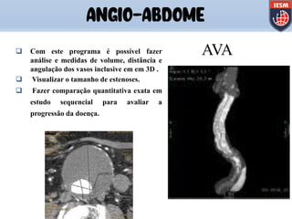 ANGIO-ABDOME
AVAq Com este programa é possível fazer
análise e medidas de volume, distância e
angulação dos vasos inclusive em em 3D .
q Visualizar o tamanho de estenoses.
q Fazer comparação quantitativa exata em
estudo sequencial para avaliar a
progressão da doença.
 