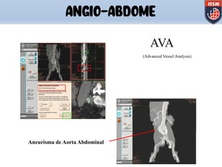 ANGIO-ABDOME
AVA
(Advanced Vessel Analysis)
Aneurisma de Aorta Abdominal
 