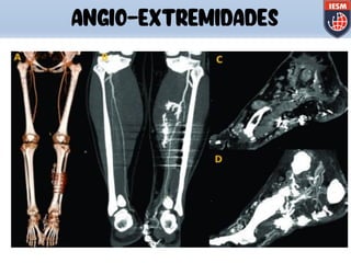 ANGIO-EXTREMIDADES
 