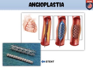 STENT
ANGIOPLASTIA
 