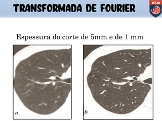 TRANSFORMADA DE FOURIER
Espessura do corte de 5mm e de 1 mm
 