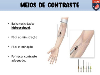 MEIOS DE CONTRASTE
• Baixa toxicidade:
hidrossolúvel.
• Fácil administração
• Fácil eliminação
• Fornecer contraste
adequado.
 