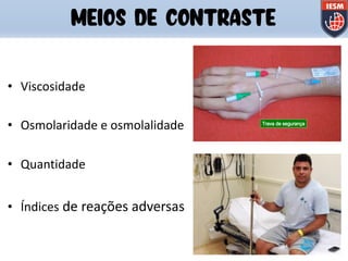 • Viscosidade
• Osmolaridade e osmolalidade
• Quantidade
• Índices de reações adversas
MEIOS DE CONTRASTE
 