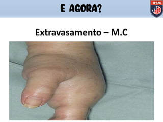 Extravasamento – M.C
E AGORA?
 