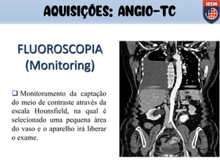 FLUOROSCOPIA
(Monitoring)
q Monitoramento da captação
do meio de contraste através da
escala Hounsfield, na qual é
selecionado uma pequena área
do vaso e o aparelho irá liberar
o exame.
AQUISIÇÕES: ANGIO-TC
 