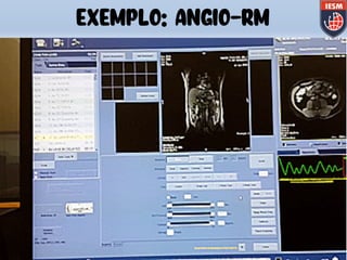 EXEMPLO: ANGIO-RM
 