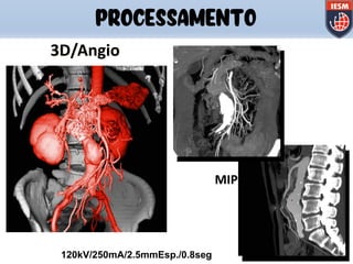 PROCESSAMENTO
120kV/250mA/2.5mmEsp./0.8seg
3D/Angio
MIP
 