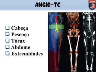 ANGIO-TC
q Cabeça
q Pescoço
q Tórax
q Abdome
q Extremidades
 