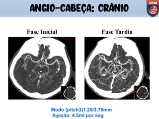 ANGIO-CABEÇA: CRÂNIO
Injeção: 4.5ml por seg
Fase Inicial Fase Tardia
Modo (pitch3)1.25/3.75mm
 