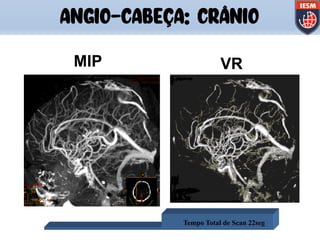 Pausa de 15seg
Tempo Total de Scan 22seg
MIP VR
ANGIO-CABEÇA: CRÂNIO
 