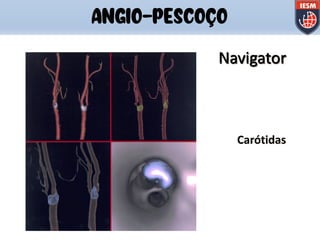 Carótidas
Navigator
ANGIO-PESCOÇO
 