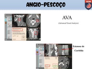 AVA
(Advanced Vessel Analysis)
Estenose de
Carótida
ANGIO-PESCOÇO
 