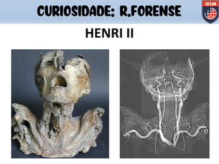 CURIOSIDADE: R.FORENSE
HENRI II
 