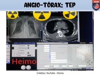 ANGIO-TÓRAX: TEP
Créditos: YouTube - Heimo
 