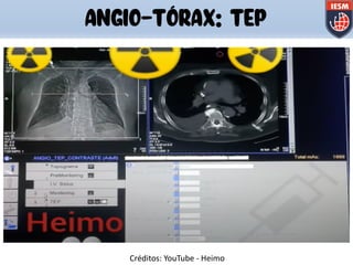 ANGIO-TÓRAX: TEP
Créditos: YouTube - Heimo
 