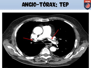 ANGIO-TÓRAX: TEP
 