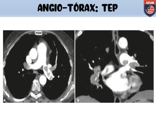 ANGIO-TÓRAX: TEP
 