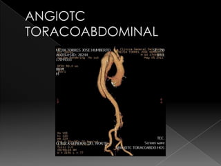 Angiotc toracoabdominal