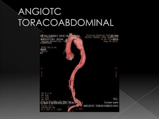 Angiotc toracoabdominal