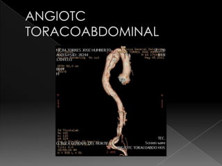 Angiotc toracoabdominal