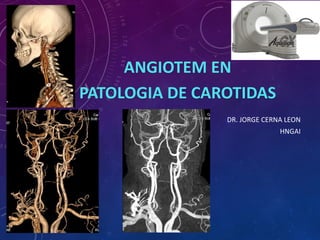 DR. JORGE CERNA LEON
HNGAI
ANGIOTEM EN
PATOLOGIA DE CAROTIDAS
 