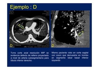 Ejemplo : D




D                                         D

Tcms corte axial resolución MIP se        Mismo paciente visto en corte sagital
evidencia defecto de relleno proyectado   con zoom que demuestra en trombo
a nivel de arteria subsegmentaría para    en segmento lobar basal inferior
lóbulo inferior derecho.                  izquierdo
 