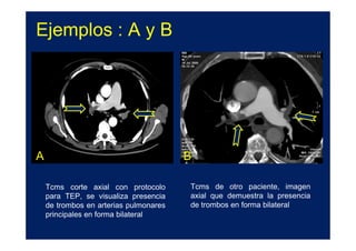 Ejemplos : A y B




A                                       B

    Tcms corte axial con protocolo      Tcms de otro paciente, imagen
    para TEP, se visualiza presencia    axial que demuestra la presencia
    de trombos en arterias pulmonares   de trombos en forma bilateral
    principales en forma bilateral
 